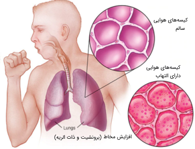 عفونت‌ های دستگاه تنفسی تحتانی