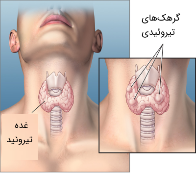 گرهک‌ های تیروئیدی