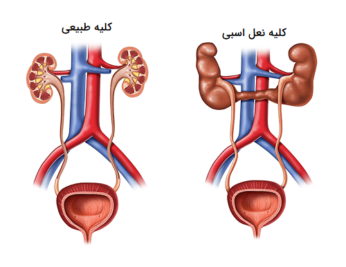 بیمار کلیه نعل اسبی