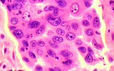 کارسینوما سلولی بزرگ