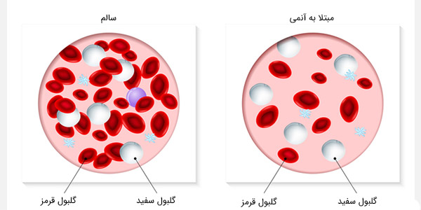 آنمی هیپوکروم