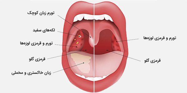 فارنژیت ویروسی