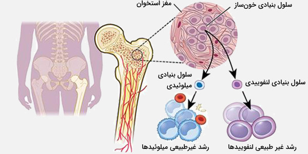 سرطان میلویید