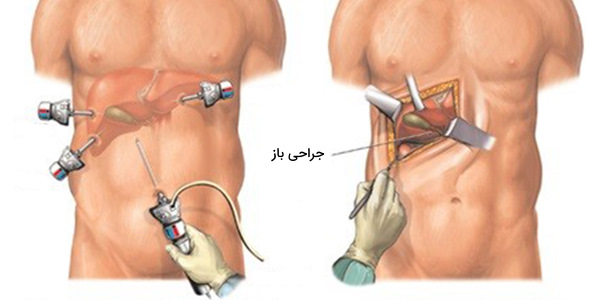 جراحی کیسه صفرا