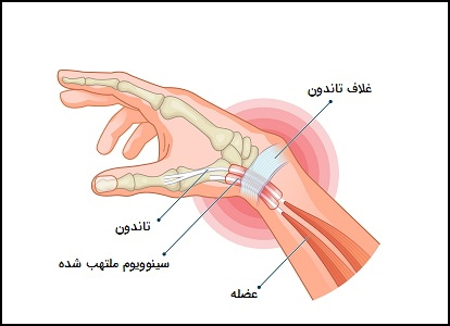 التهاب تاندون دست