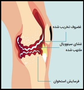 عکس روماتیسم مفصلی