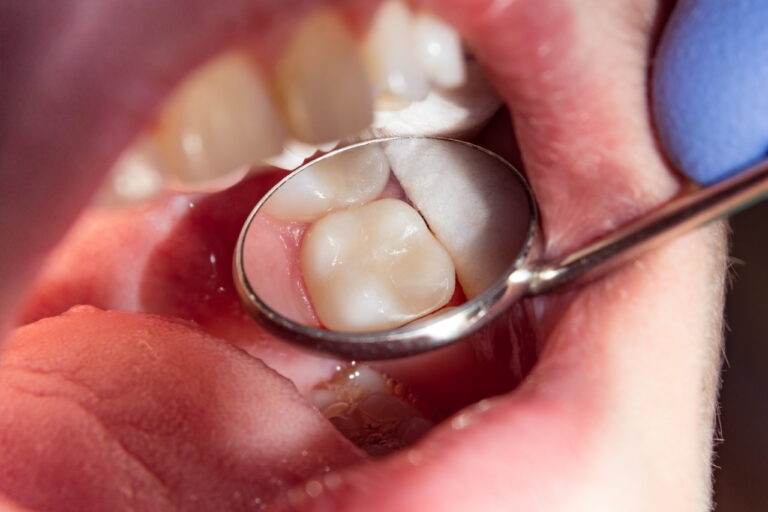 پرکردن دندان چیست و چه موقع باید به دندانپزشک مراجعه کنیم؟