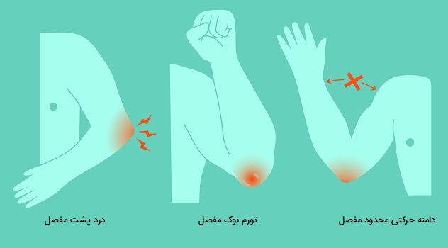 علائم بورسیت