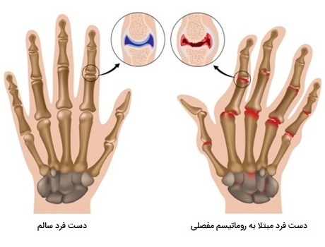 شکل روماتیسم مفصلی