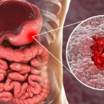 علائم زخم معده – چه زمان باید به پزشک مراجعه کنیم؟