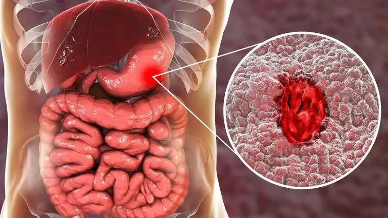 علائم زخم معده — چه زمان باید به پزشک مراجعه کنیم؟