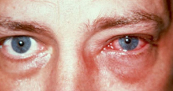 آدنو ویروس چشمی