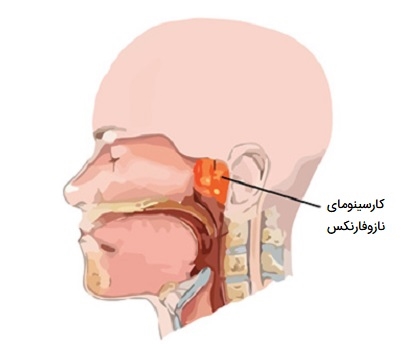 کارسینومای نازوفارنکس