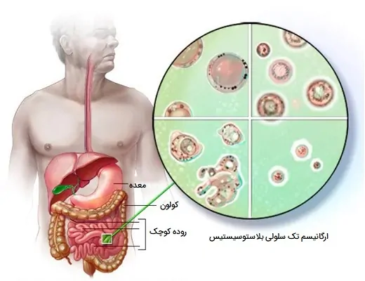 بلاستوسیستیس هومینیس