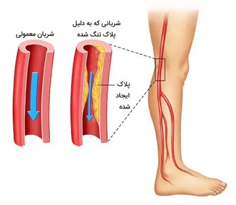 بیماری شریان محیطی