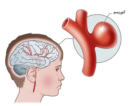 عوارض فشار خون آنوریسم