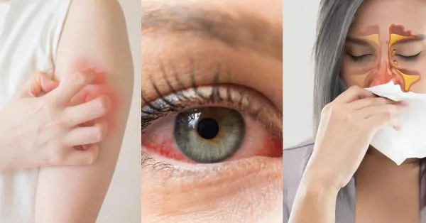 رفع آلرژی با هیپنوتیزم