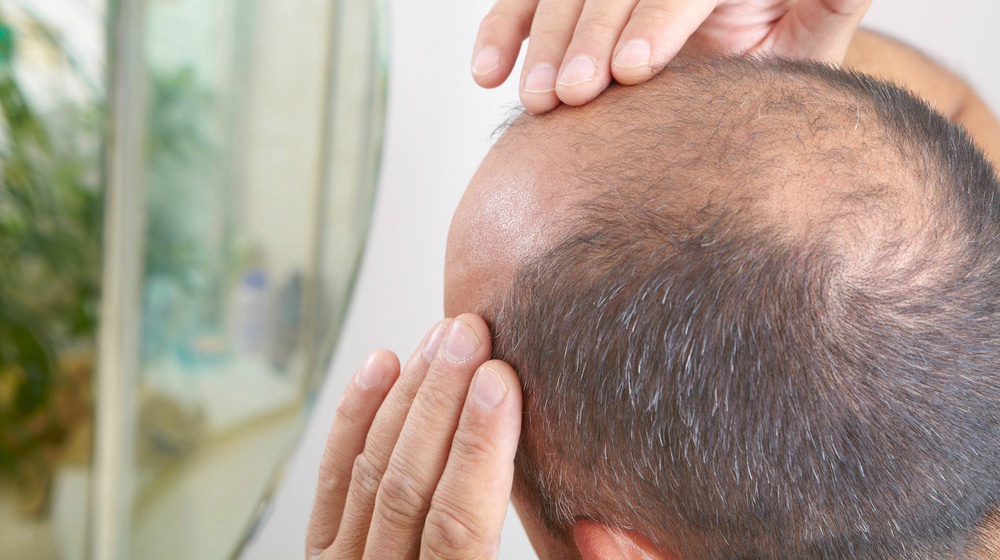 ژن درمانی برای مو