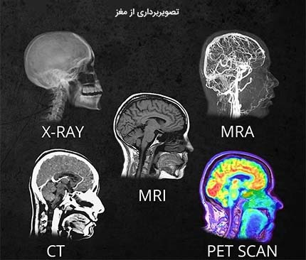 تصویربرداری از مغز