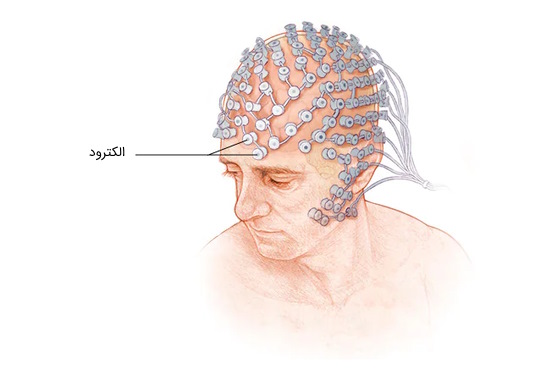 EEG چیست