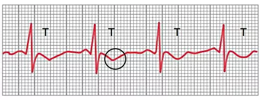 اختلالات موج T