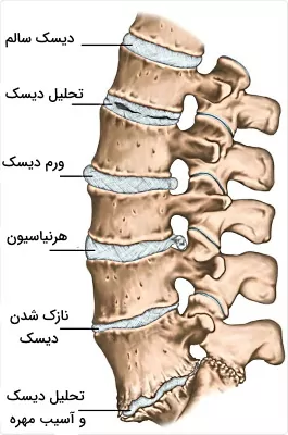 بیماری دیسک کمر