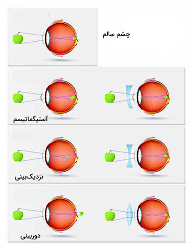 عیوب انکساری در اپتومتری