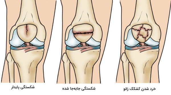 شکل استخوان کشکک زانو در انواع شکستگی 