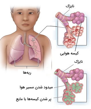 ریه کودکان - بیماری های تنفسی کودکان 