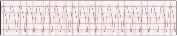 نوار قلب بیمار مبتلا به تاکی کاردی بدون نبض - احیای قلبی پیشرفته