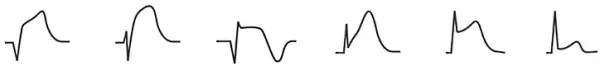 تغییرات قطعه st در ecg - نوار قلب ناسالم