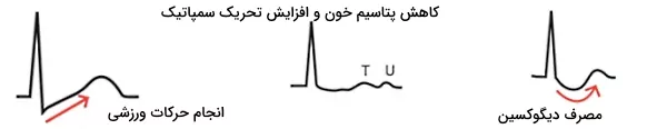 تغییر قطعه st در ecg