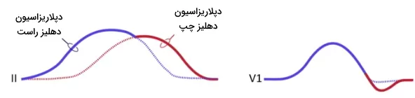 موج p در ecg نرمال