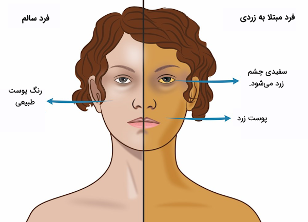 مقایسه رنگ پوست و سفیدی چشم فرد سالم با فرد مبتلا به زردی