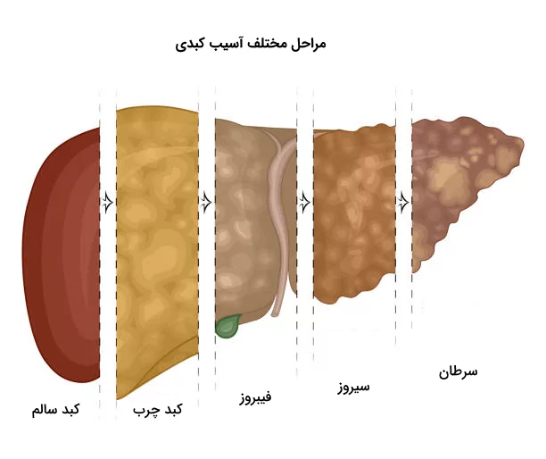 مراحل مختلف آسیب کبدی