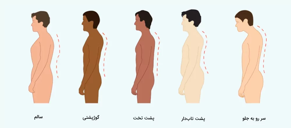 وضعیت ستون فقرات و حالات بدن در اختلالات مختلف