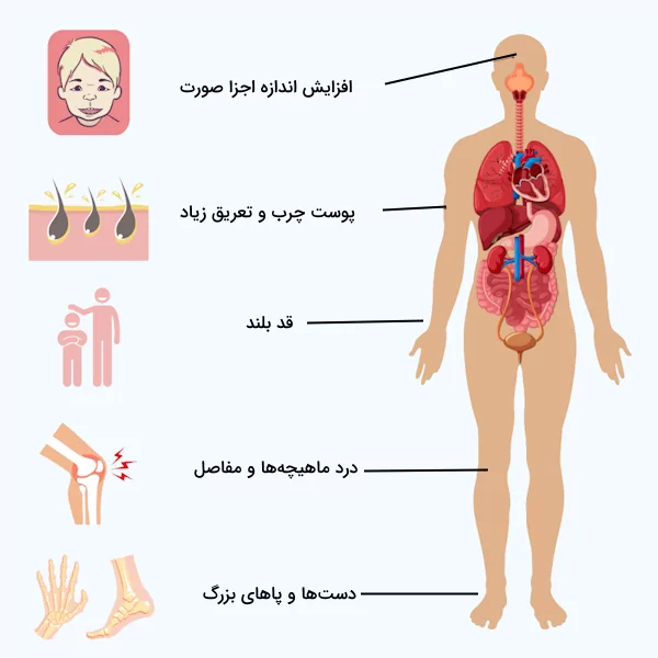 علائم آکرومگالی