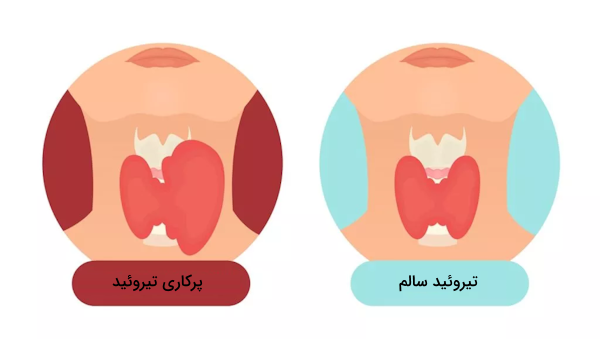 مقایسه اندازه تیروئید سالم و تیروئيد پرکار