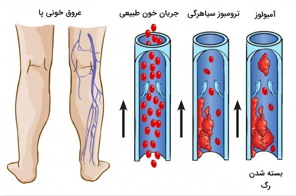 ترومبوز سیاهرگی و بسته شدن عروق پا