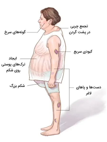 علائم سندروم کوشینگ