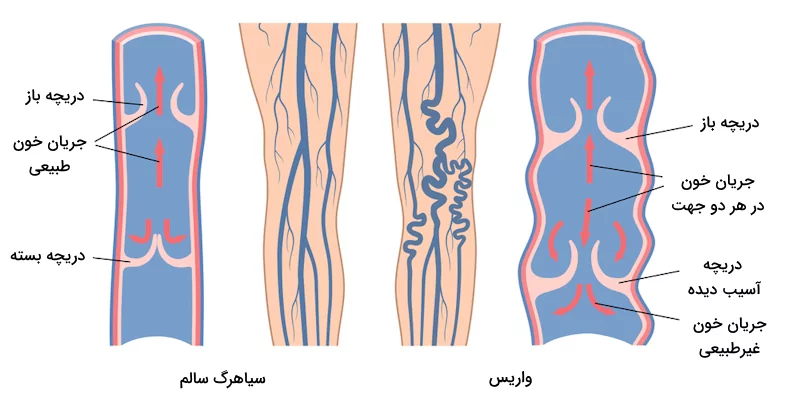 تفاوت دریچه های سیاهرگی در افراد سالم و افراد مبتلا به واریس