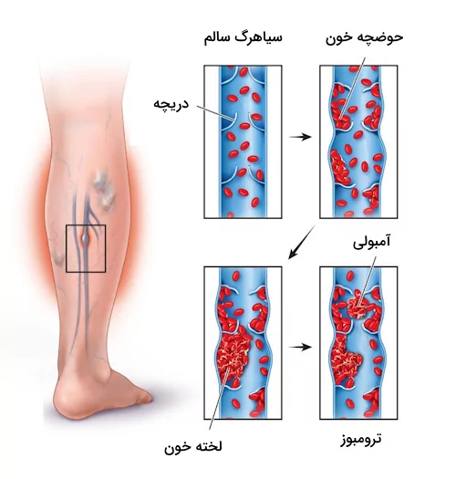 روند رخ داده در بیماری ترومبوز سیاهرگی عمقی برای سیاهرگ های عمقی درون پا