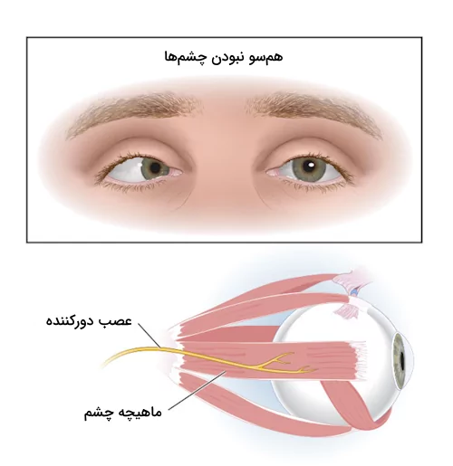 محل قرارگیری عصب دور کننده و اثر آسیب به آن روی حرکات چشم