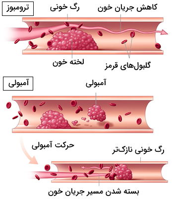 پیامدها تشکیل لخته خون در دیواره رگ و حرکت لخته خون در رگ ها