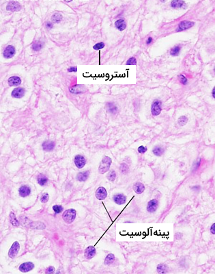 تصویری از بافت غده پینه آل که با روش رنگ‌آمیزی هماتوکسیلین-ائوزین رنگ آمیزی شده است.