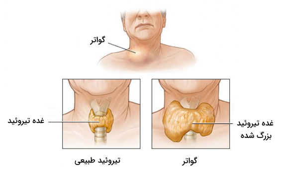 مقایسه تیروئید فردی که گواتر دارد با فردی که تیروئید طبیعی دارد.