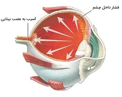 عوارض فشار چشم