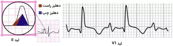 تغییر موج p در ecg - نوار قلب خطرناک