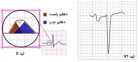 تغییر موج p در ekg - بزرگ شدن دهلیز در نوار قلب